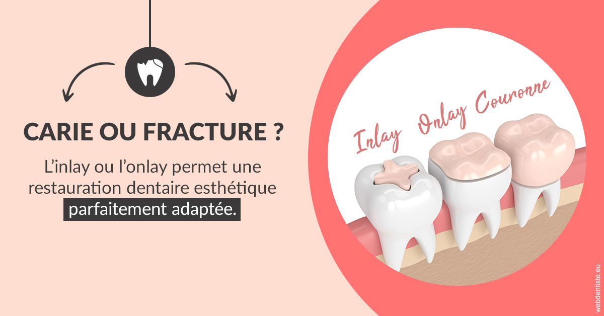 https://www.dentisteivry.fr/T2 2023 - Carie ou fracture 2