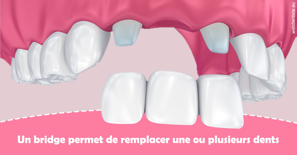 https://www.dentisteivry.fr/Bridge remplacer dents 2