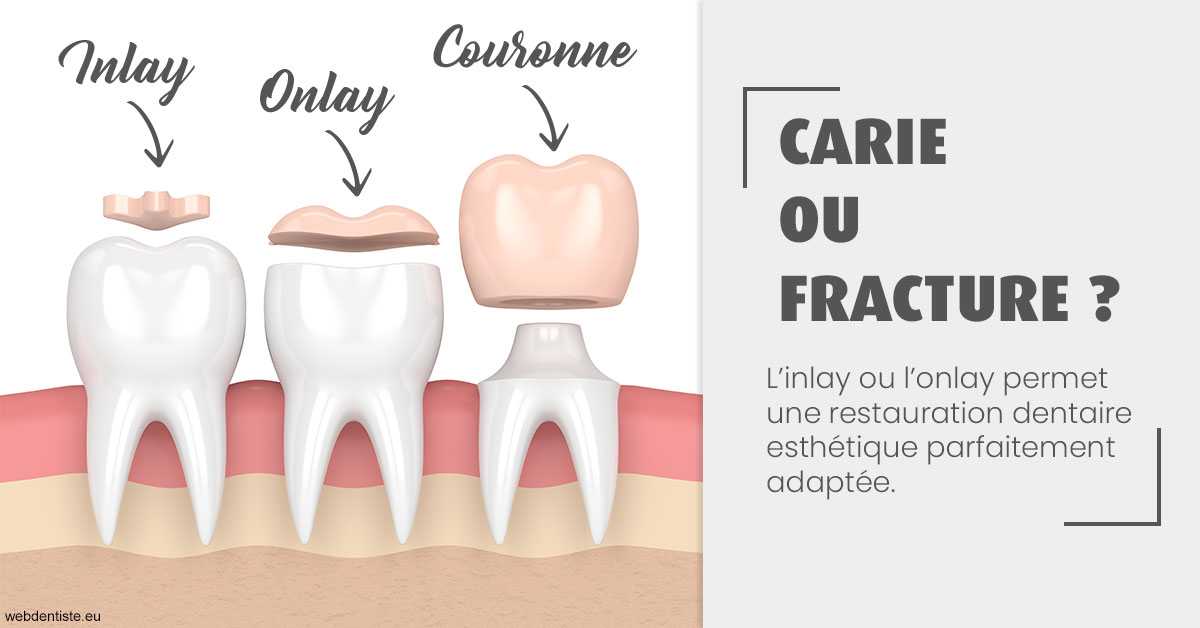 https://www.dentisteivry.fr/T2 2023 - Carie ou fracture 1