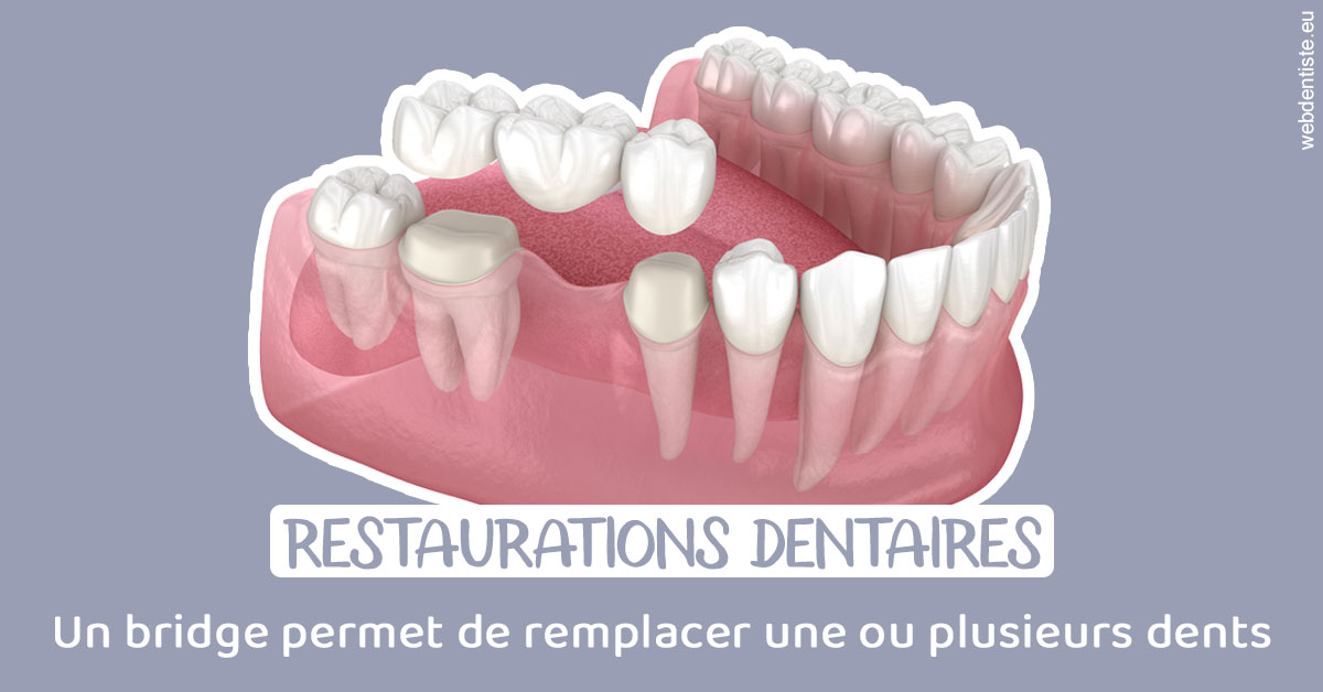 https://www.dentisteivry.fr/Bridge remplacer dents 1