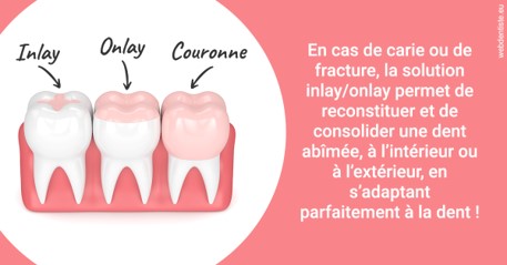 https://www.dentisteivry.fr/L'INLAY ou l'ONLAY 2