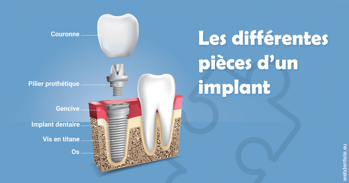 https://www.dentisteivry.fr/Les différentes pièces d’un implant 1