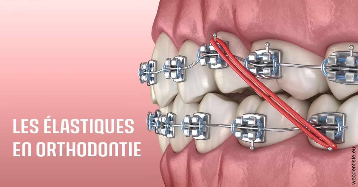 https://www.dentisteivry.fr/Elastiques orthodontie 2