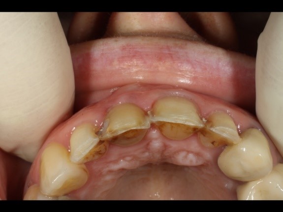Facette dentaire 5