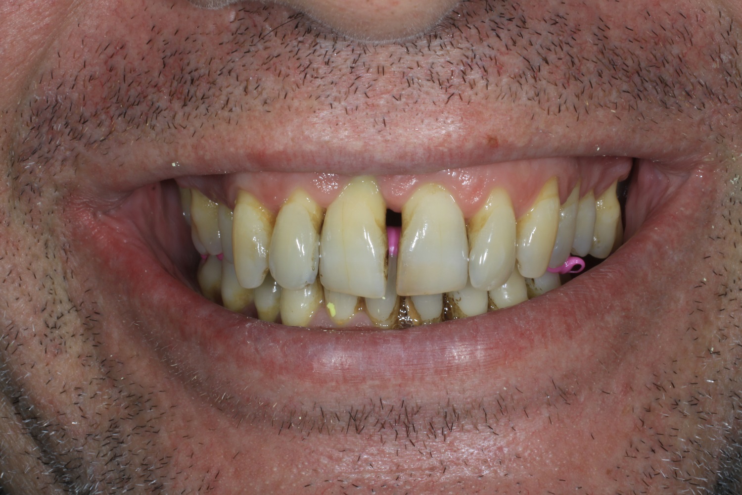 implant complet 1